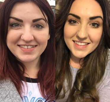 Invisalign - Before and After