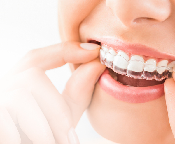 Invisalign Aligners