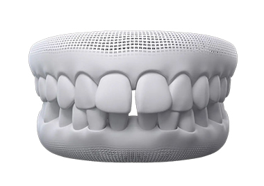 Treatment for Gaps between teeth
