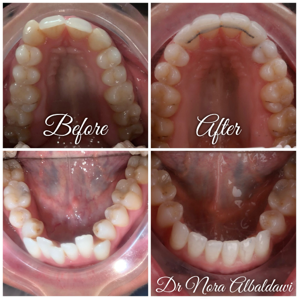 Teeth Image -Beautiful Smiles Dental