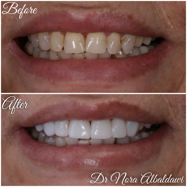 Teeth Image -Beautiful Smiles Dental