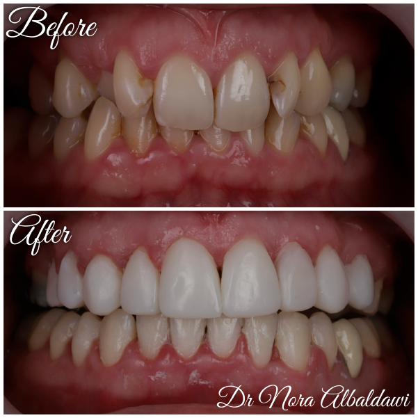Teeth Image -Beautiful Smiles Dental