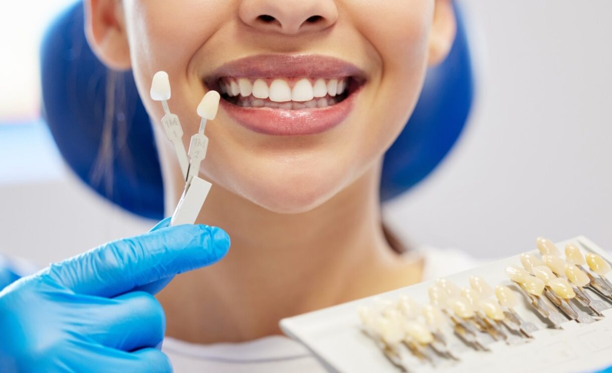 Composite Bonding Over Other Dental Treatments