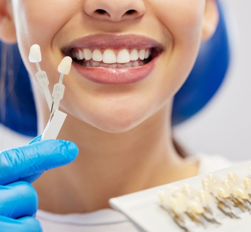 Composite Bonding Over Other Dental Treatments