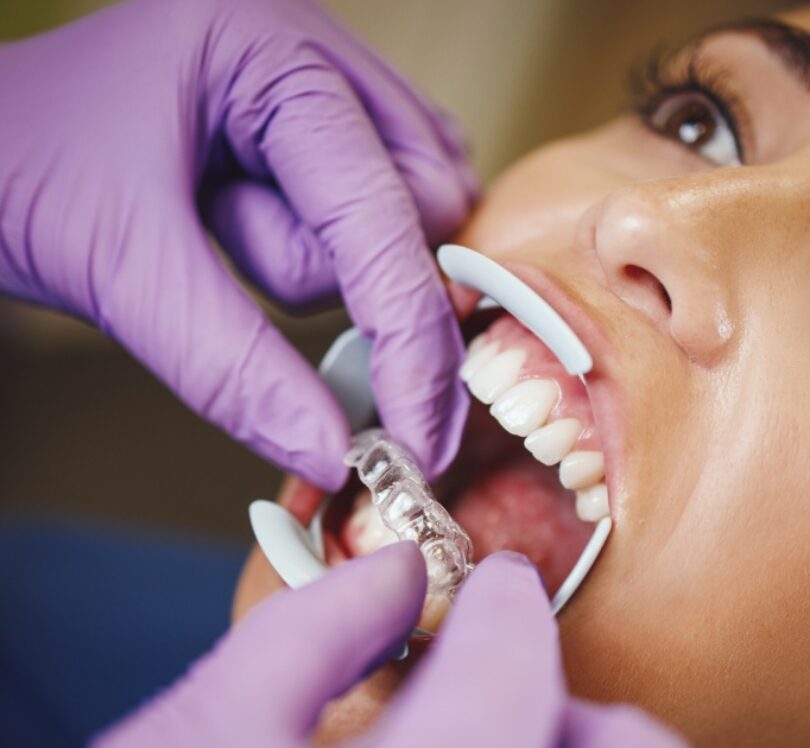 Care for Teeth During the Straightening